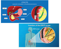 Diepgaande inzichten in ERCP: Een Medische Verkenning